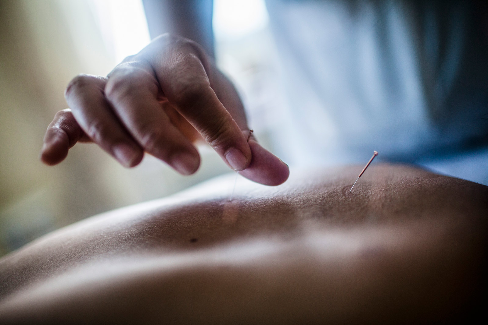 Terapia de acupuntura