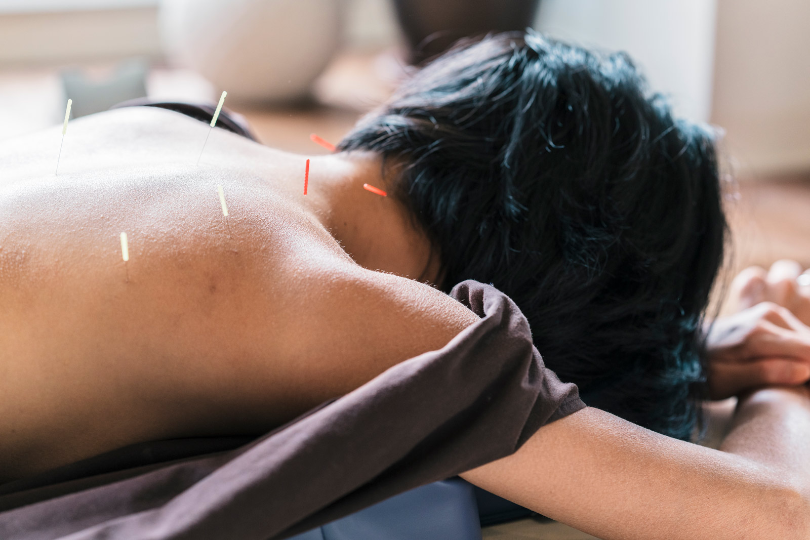 Terapia de acupuntura en mujer tumbada