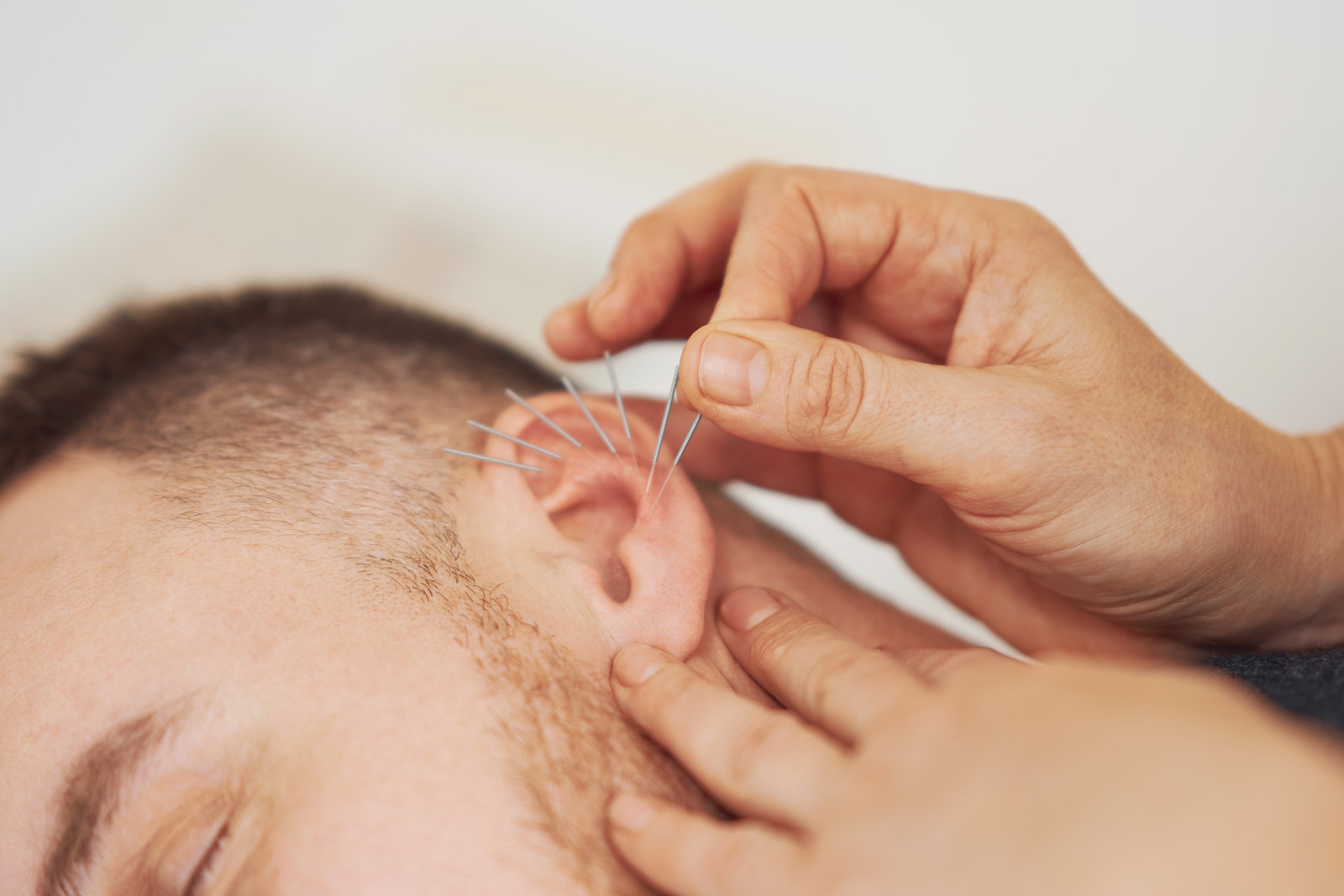Terapia de acupuntura en oreja
