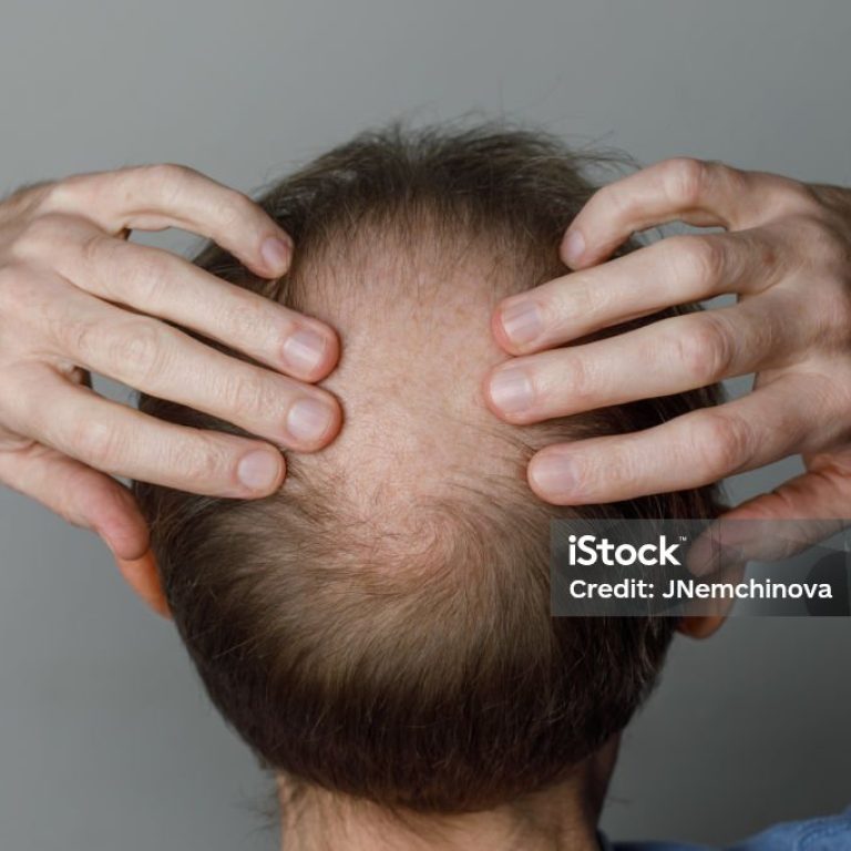 Baldness men's head with thin hair on his top head close up. Hairloss and alopecia concept.